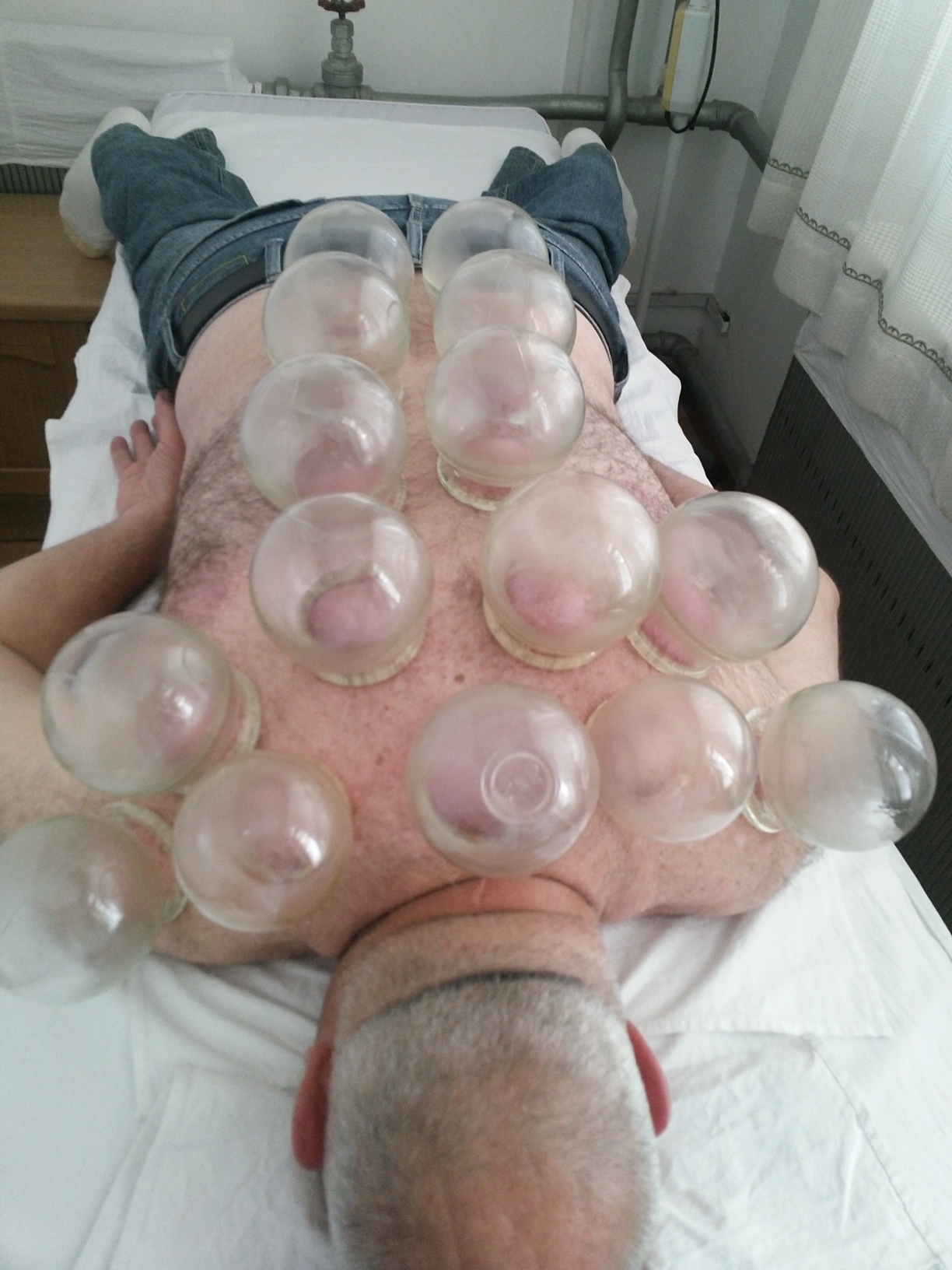 2209 Cupping
